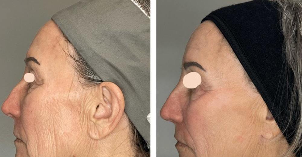 Why Fall is the Best Season for Laser Treatments