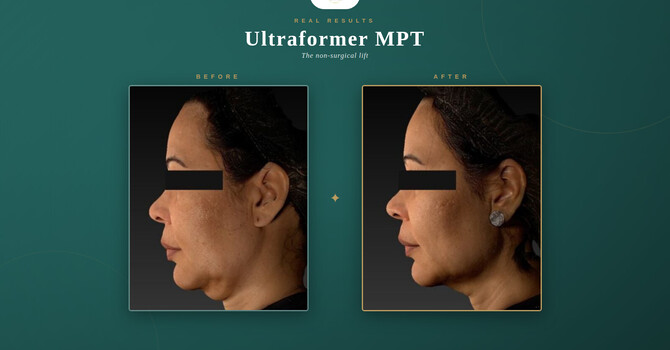 The Lift Lab — An Exclusive Ultraformer MPT Launch