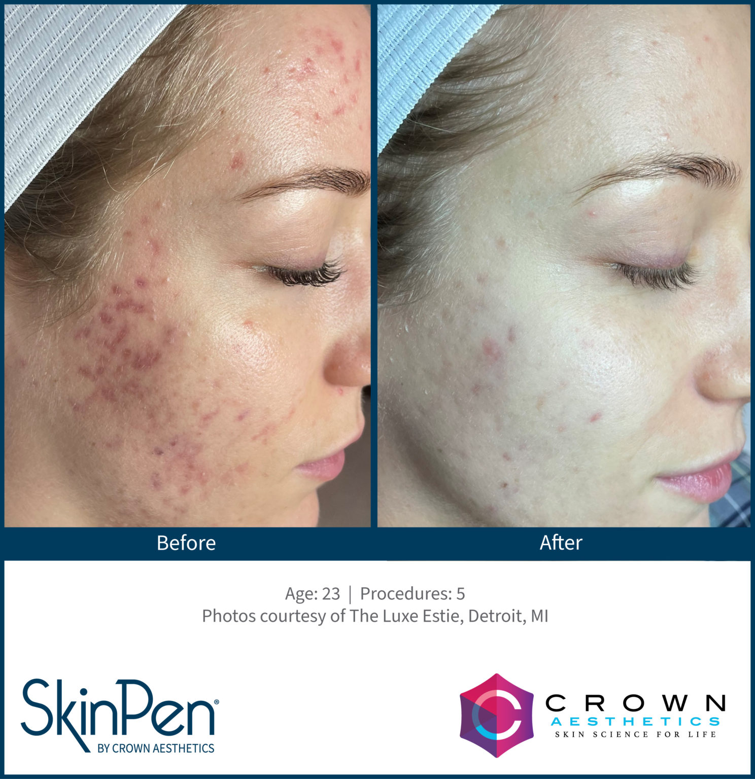 SkinPen Microneedling - Aspen Aesthetics