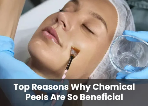 Top Reasons Why Chemical Peels Are So Beneficial!