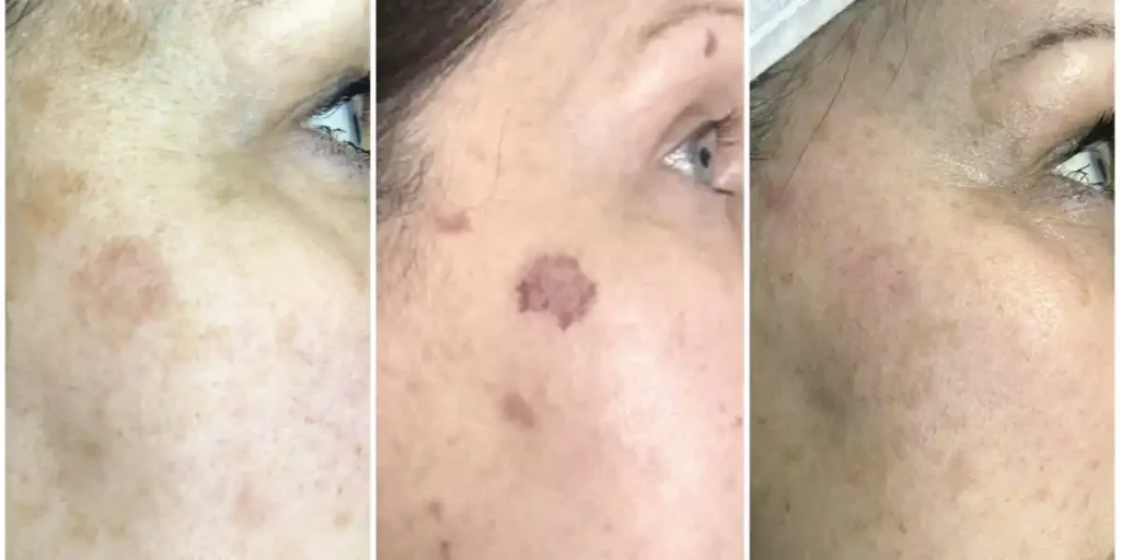 What to Avoid After Laser Treatment on Face?